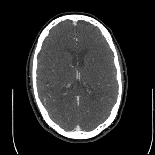 File:Acute A3 occlusion with ACA ischemic penumbra (CT perfusion) (Radiopaedia 72036-82527 Axial C+ arterial phase thins 51).jpg
