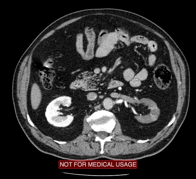 File:Acute aortic dissection - Stanford type A (Radiopaedia 40661-43285 Axial C+ portal venous phase 102).jpg