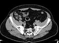 Acute appendicitis (Radiopaedia 13030-13091 Axial non-contrast 53).jpg