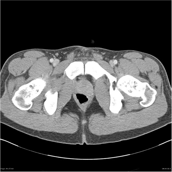 File:Acute appendicitis (Radiopaedia 25364-25615 B 74).jpg