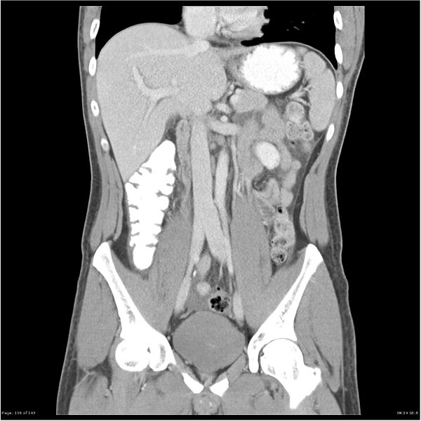 File:Acute appendicitis (Radiopaedia 25364-25615 C+ portal venous phase 13).jpg