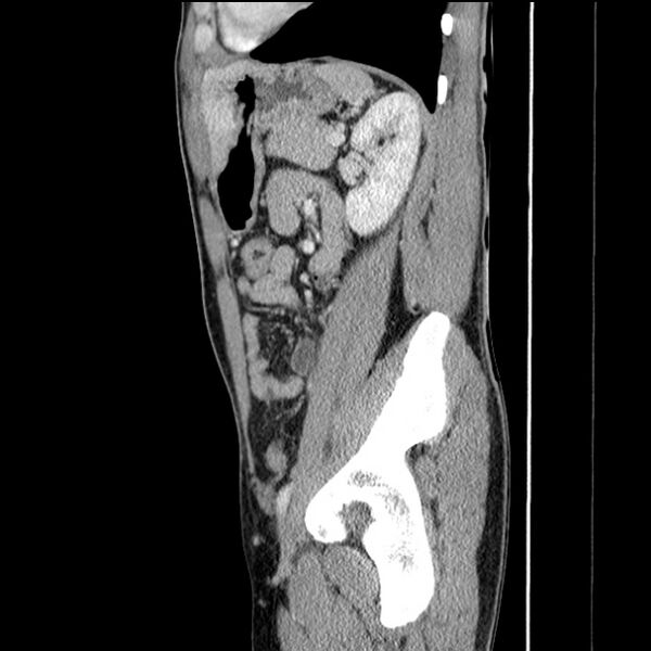 File:Acute appendicitis (Radiopaedia 27049-27227 Sagittal C+ portal venous phase 56).jpg