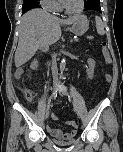 File:Acute appendicitis (Radiopaedia 58627-65818 Coronal non-contrast 40).jpg
