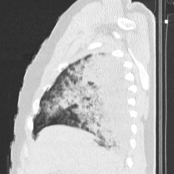 File:Acute aspiration pneumonitis (Radiopaedia 33605-34703 Sagittal lung window 22).jpg
