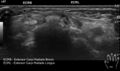 Acute calcific periarthritis - wrist (Radiopaedia 76314).jpg