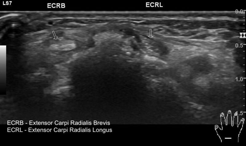 File:Acute calcific periarthritis - wrist (Radiopaedia 76314).jpg