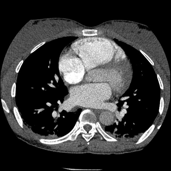 File:Acute chest syndrome - sickle cell disease (Radiopaedia 42375-45499 Axial C+ CTPA 105).jpg