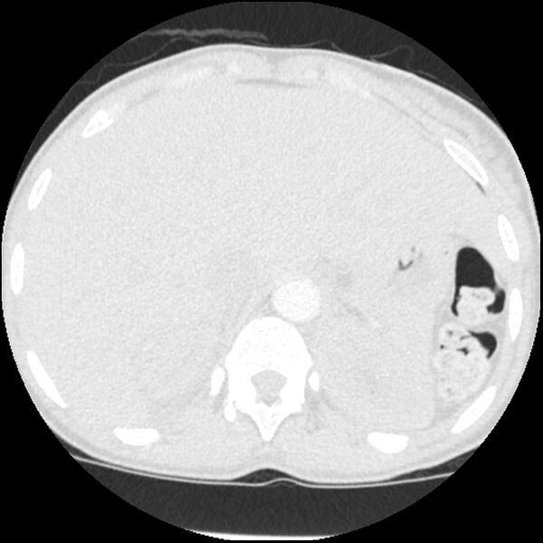 File:Acute chest syndrome - sickle cell disease (Radiopaedia 42375-45499 Axial lung window 184).jpg