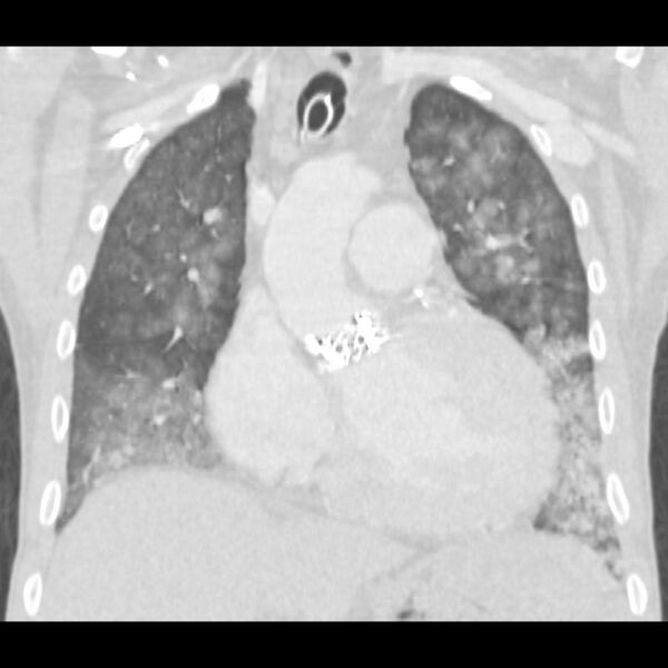 File:Acute diffuse alveolar hemorrhage (Radiopaedia 41323-44158 Coronal lung window 18).jpg