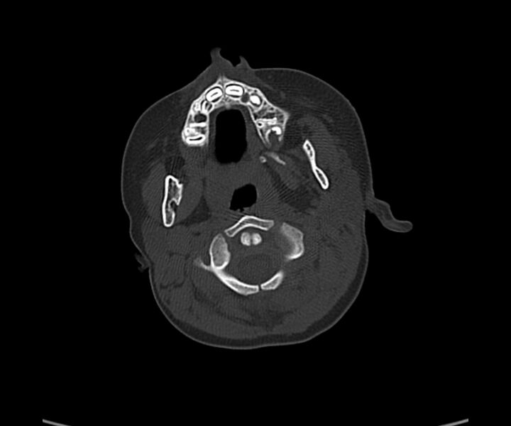 File:Acute hemorrhagic contusion (Radiopaedia 63660-72336 Axial bone window 6).jpg