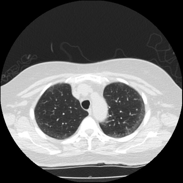 File:Acute interstitial pneumonitis (Radiopaedia 45404-49444 Axial lung window 24).jpg