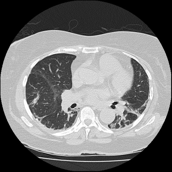 File:Acute interstitial pneumonitis (Radiopaedia 45404-49452 Axial lung window 50).jpg