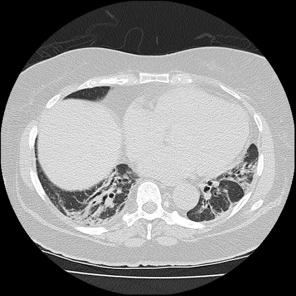 File:Acute interstitial pneumonitis (Radiopaedia 45404-49452 Axial lung window 62).jpg