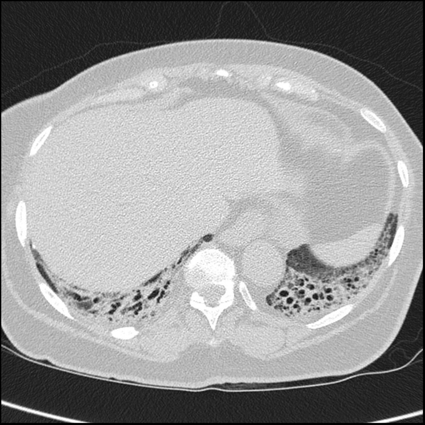 Acute interstitial pneumonitis (Radiopaedia 45404-49453 Axial lung window 66).jpg