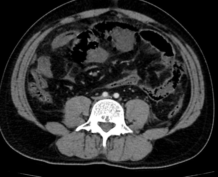 File:Acute mesenteric ischemia - superior mesenteric artery thrombosis (Radiopaedia 73947-84776 Axial C+ arterial phase 91).jpg
