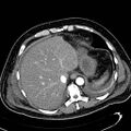 Acute pancreatic necrosis (Radiopaedia 13560-13486 Axial C+ portal venous phase 28).jpg