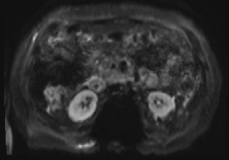 File:Acute portal vein thrombosis (Radiopaedia 73198-83925 Axial DWI 22).jpg