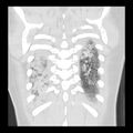Acute pulmonary edema on CT (Radiopaedia 33582-34672 Coronal lung window 34).jpg