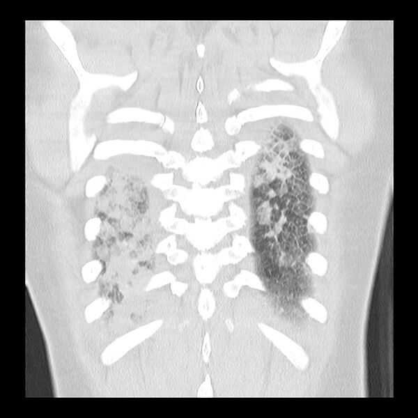 File:Acute pulmonary edema on CT (Radiopaedia 33582-34672 Coronal lung window 34).jpg