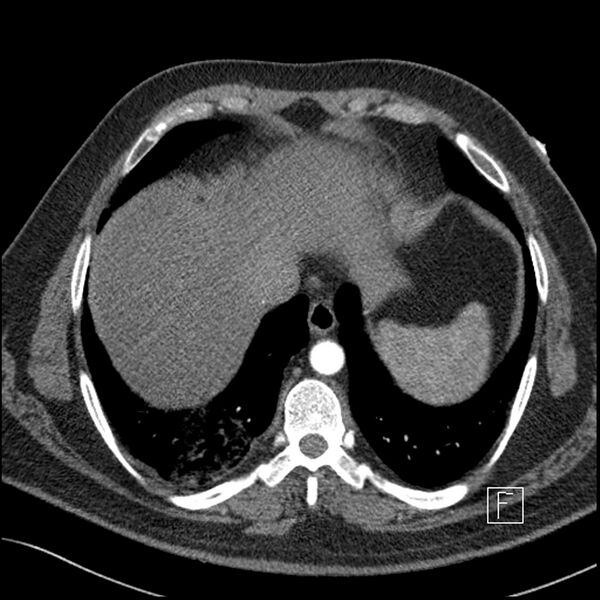 File:Acute pulmonary embolism with pulmonary infarct (Radiopaedia 73062-83768 Axial C+ CTPA 62).jpg