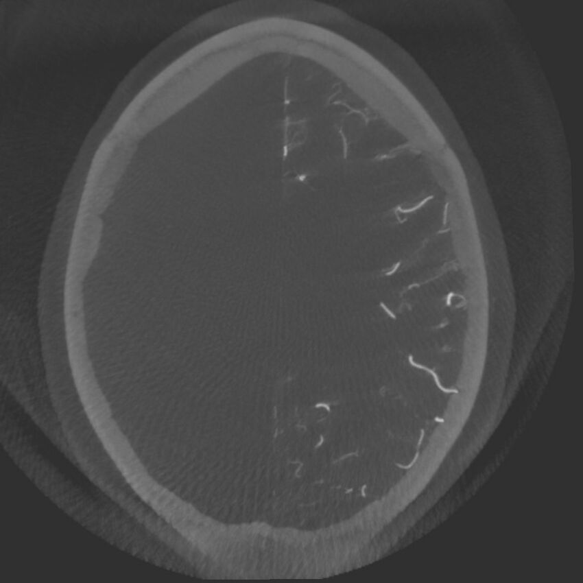 Acute subarachnoid hemorrhage and accessory anterior cerebral artery (Radiopaedia 69231-79010 C 56).jpg