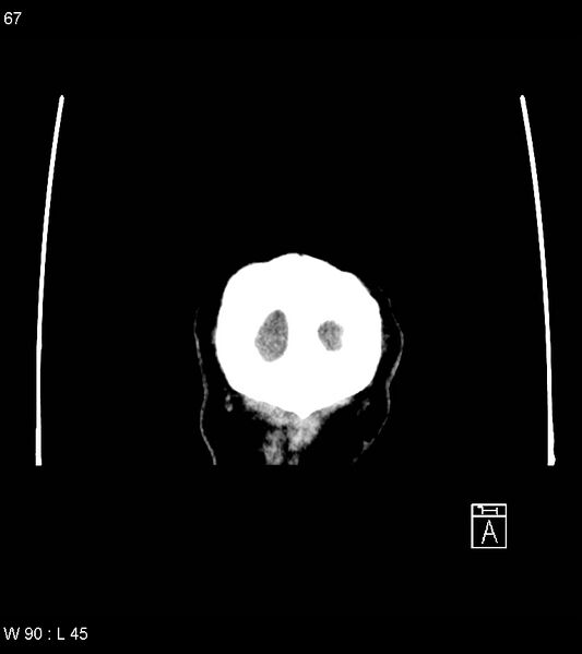 File:Acute subdural hematoma with myelofibrosis (Radiopaedia 52582-58494 Coronal non-contrast 58).jpg