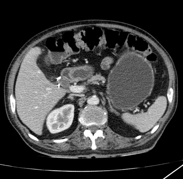 File:Adenocarcinoma of colon with entero-colic fistula (Radiopaedia 22832-22852 Axial C+ portal venous phase 24).jpg