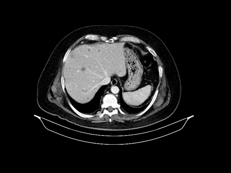 File:Adenocarcinoma of pancreas with hepatic metastasis (Radiopaedia 64332-73122 Axial C+ portal venous phase 18).jpg