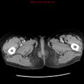 Adenocarcinoma of the colon (Radiopaedia 8191-9039 Axial liver window 84).jpg