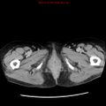 Adenocarcinoma of the colon (Radiopaedia 8191-9039 Axial renal excretory phase 68).jpg
