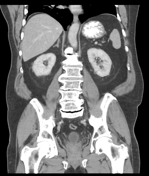 File:Adenocarcioma of rectum- T1 lesion (Radiopaedia 36921-38547 Coronal C+ portal venous phase 40).png