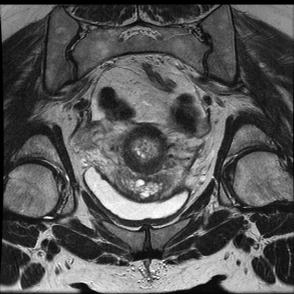 File:Adenoma malignum of the cervix (Radiopaedia 24460-24765 Coronal T2 15).jpg
