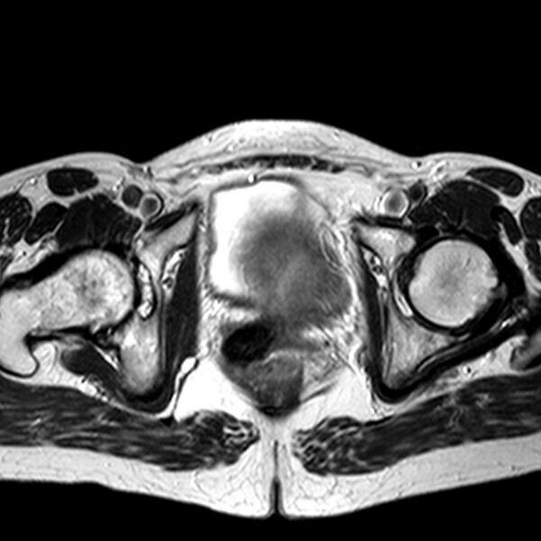 File:Adenomyoma of the uterus (huge) (Radiopaedia 9870-10438 Axial T2 10).jpg