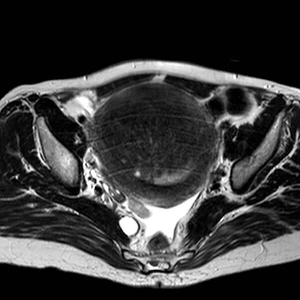 File:Adenomyoma of the uterus (huge) (Radiopaedia 9870-10438 Axial T2 22).jpg