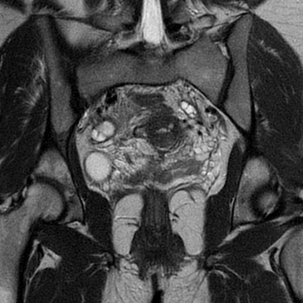 File:Adenomyosis within a septate uterus (Radiopaedia 69963-79981 Coronal T2 20).jpg