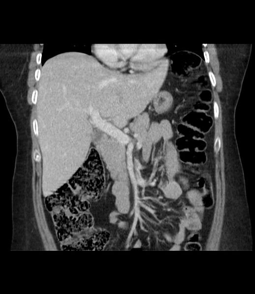 File:Adrenal cortical carcinoma with IVC invasion and thrombosis (Radiopaedia 34307-35597 Coronal C+ portal venous phase 23).jpg