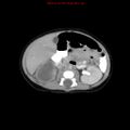 Adrenal hemorrhage (Radiopaedia 9390-10077 Axial C+ portal venous phase 13).jpg