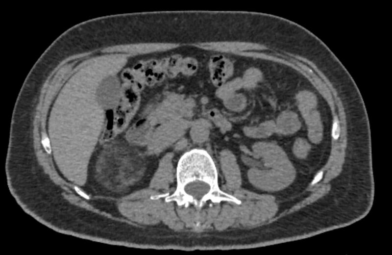 File:Adrenal myelolipoma (Radiopaedia 65240-74253 Axial non-contrast 56).jpg
