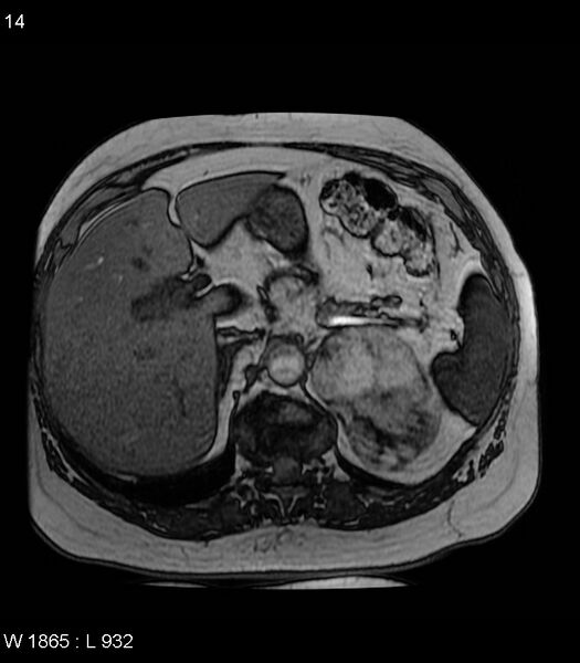 File:Adrenal myelolipoma (Radiopaedia 6765-7961 Axial T1 out-of-phase 14).jpg