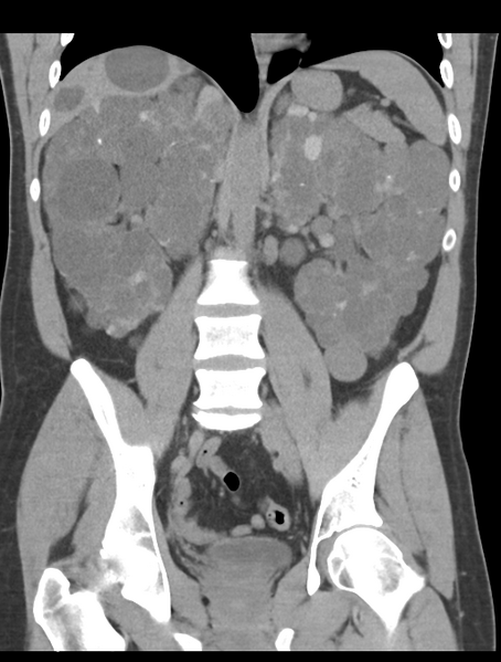 File:Adult polycystic kidney disease (Radiopaedia 47866-52626 Coronal non-contrast 29).png