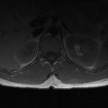 Aggressive vertebral hemangioma (Radiopaedia 39937-42404 Axial T1 4).png