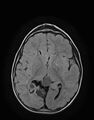 Aicardi syndrome (Radiopaedia 66029-75205 Axial FLAIR 14).jpg