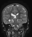 Aicardi syndrome (Radiopaedia 66029-75205 Coronal T2 15).jpg