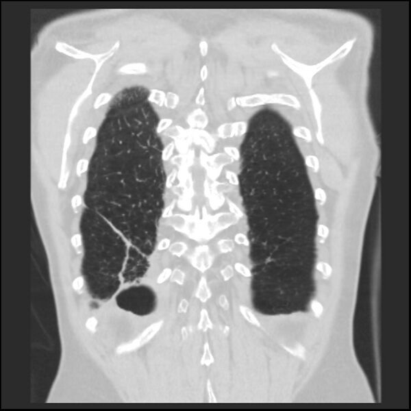File:Alpha-1-antitrypsin deficiency (Radiopaedia 40993-43722 Coronal lung window 91).jpg