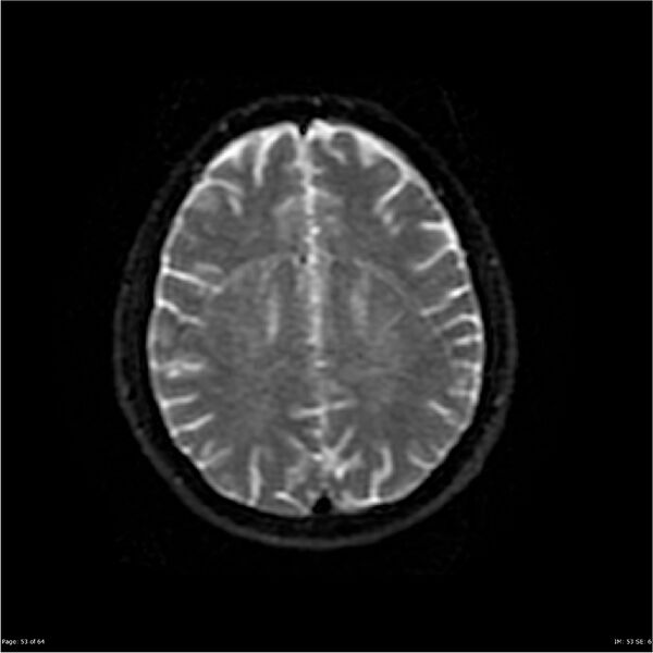 File:Amnestic syndrome secondary to hypoxic brain injury (Radiopaedia 24743-25004 DWI 53).jpg