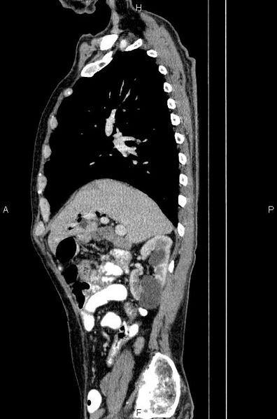 File:Ampullary adenocarcinoma (Radiopaedia 86093-102033 E 29).jpg