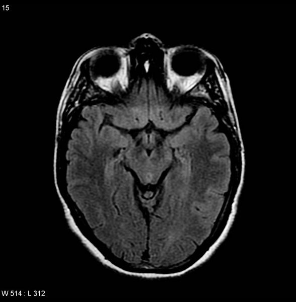 File:Amyotrophic lateral sclerosis (Radiopaedia 4719-6744 Axial FLAIR 2).jpg