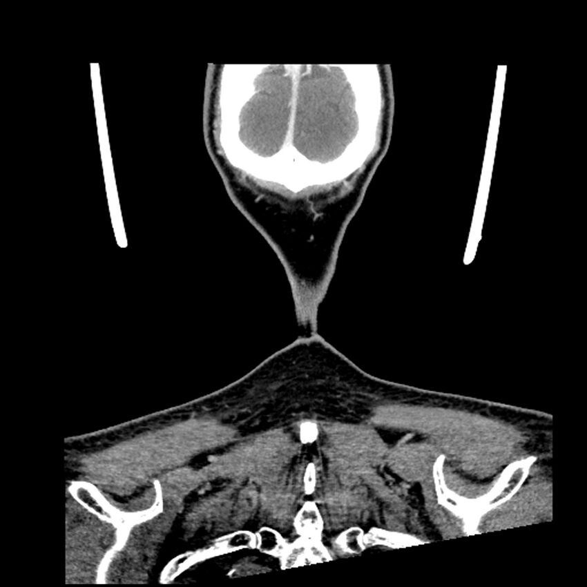 Anaplastic thyroid carcinoma (Radiopaedia 79087-92034 A 110).jpg