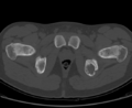Aneurysmal bone cyst of ischium (Radiopaedia 25957-26094 Axial bone window 67).png