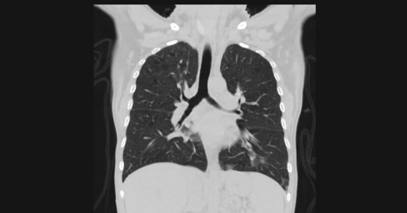 File:Angioinvasive aspergellosis (Radiopaedia 66995-76315 Coronal lung window 34).jpg